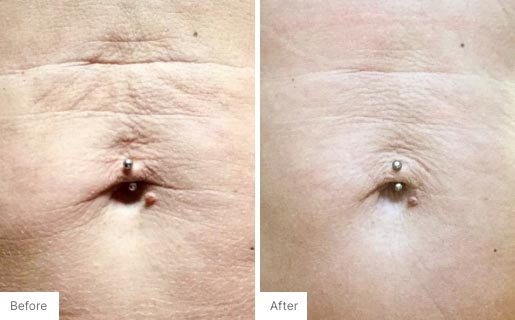 7 - Before and After Real Results photo of someone's stomach.