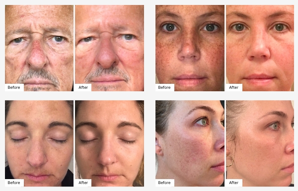 Images of actual customers' Before & After photos displaying their Real Results with IllumaBoost Vitamin C serum.